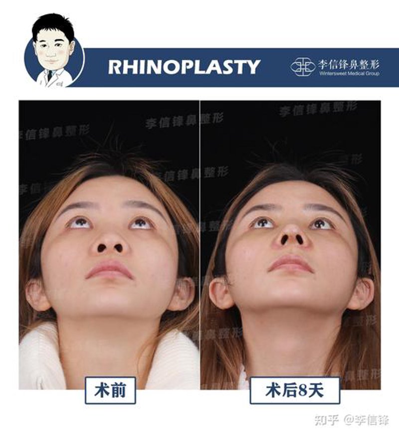 瘦脸针：从时尚到健康的美丽选择