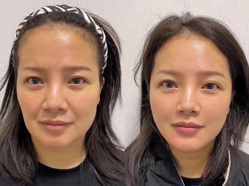 双眼皮手术：重塑魅力的美丽秘籍