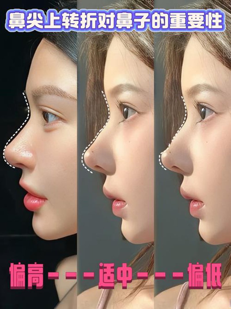 隆鼻整形